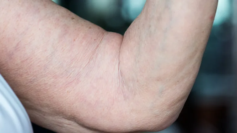 Non-Surgical Scar Treatments for Brachioplasty Scars in Turkey