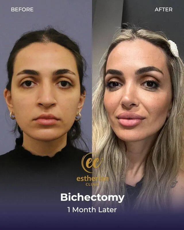 نتائج عملية استئصال الشق بعد شهر (صورة قبل وبعد من عيادة إستريان)