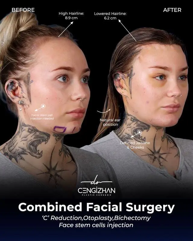 جراحة تصغير الجبهة، وتجميل الأذن، واستئصال الخدين، وحقن الخلايا الجذعية للوجه على يد الدكتور جنكيزهان إيكيزجيلي (قبل وبعد)