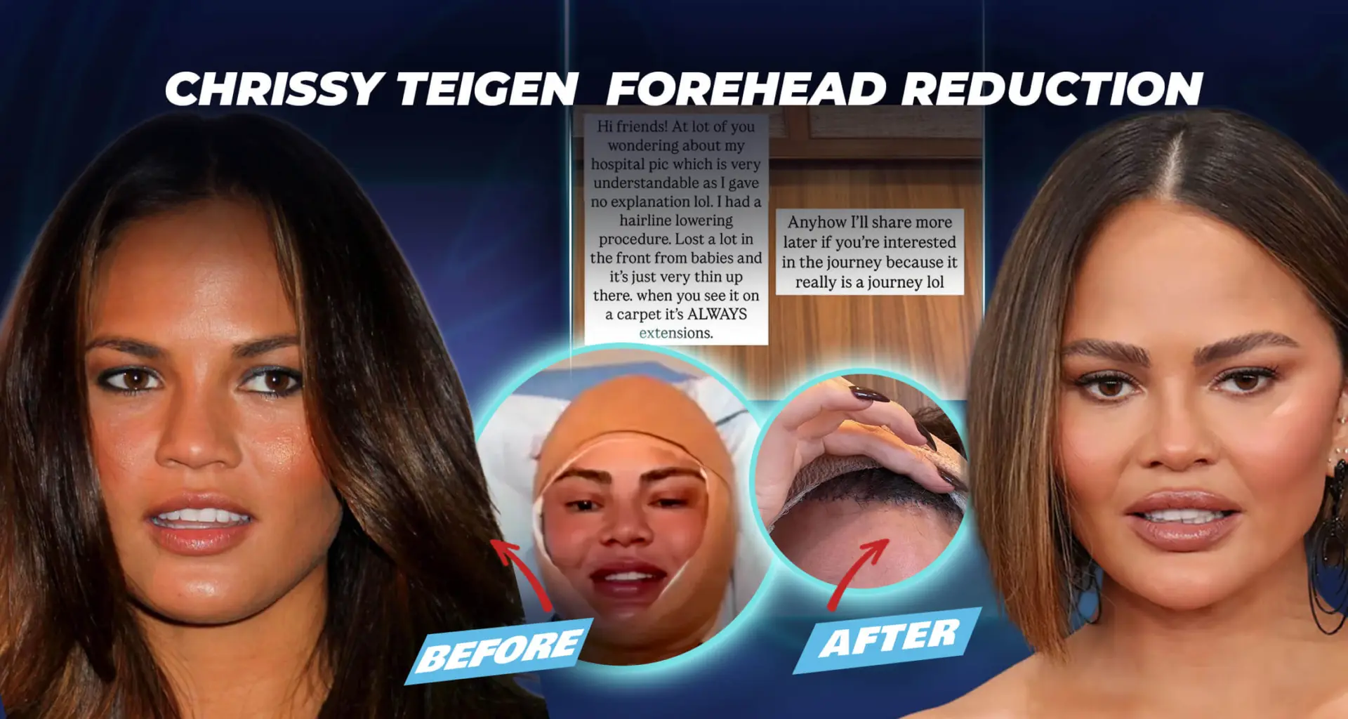 Chrissy Teigen's Forehead Reduction Surgery Results