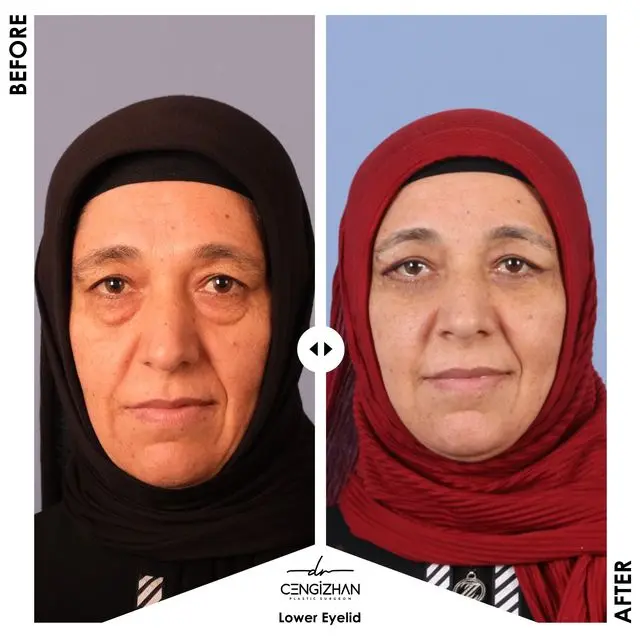 Résultats de la chirurgie des paupières inférieures (avant et après) par le Dr Cengizhan Ekizceli
