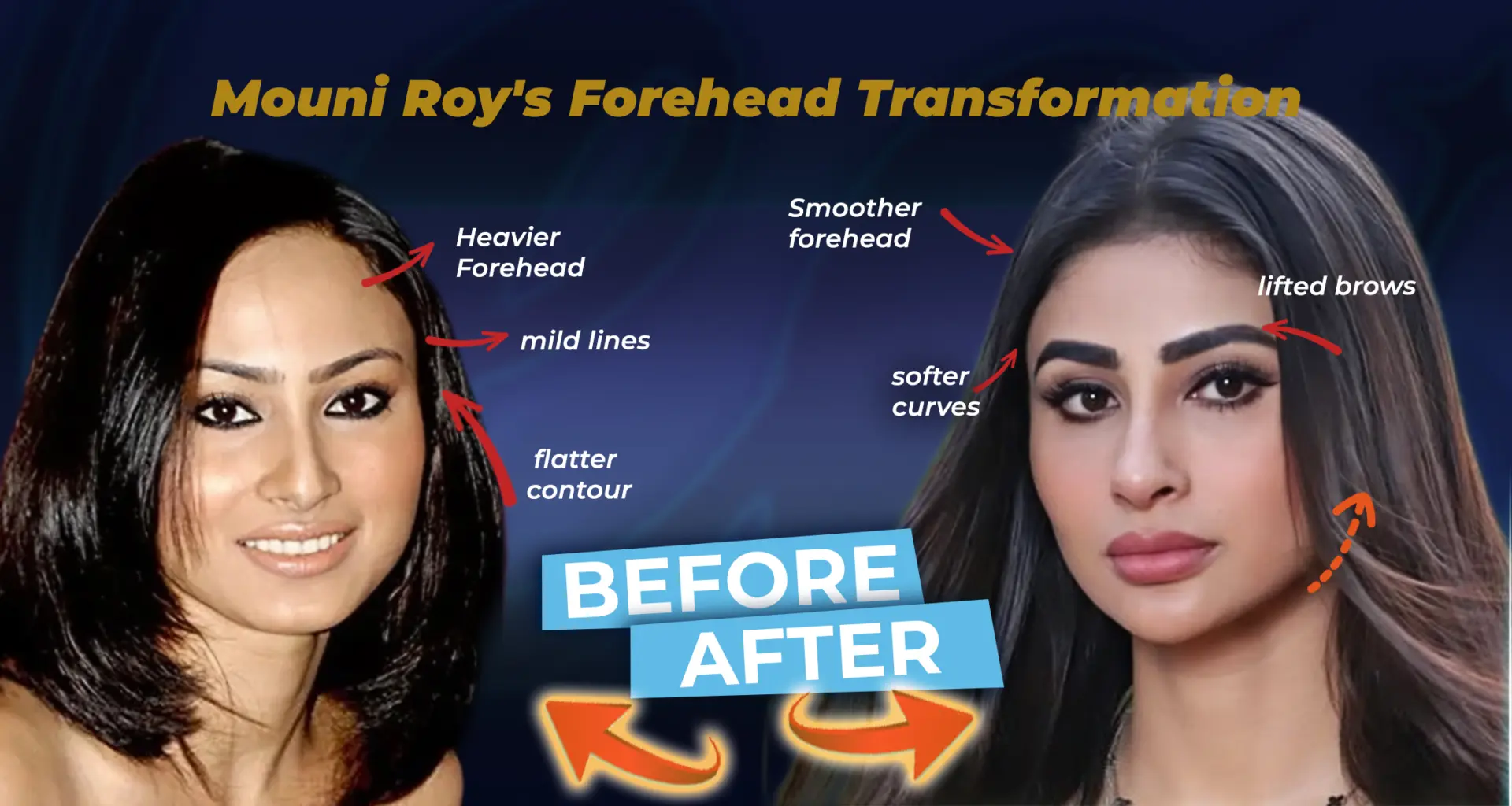 Mouni-Roy's Forehead Reduction Surgery Results