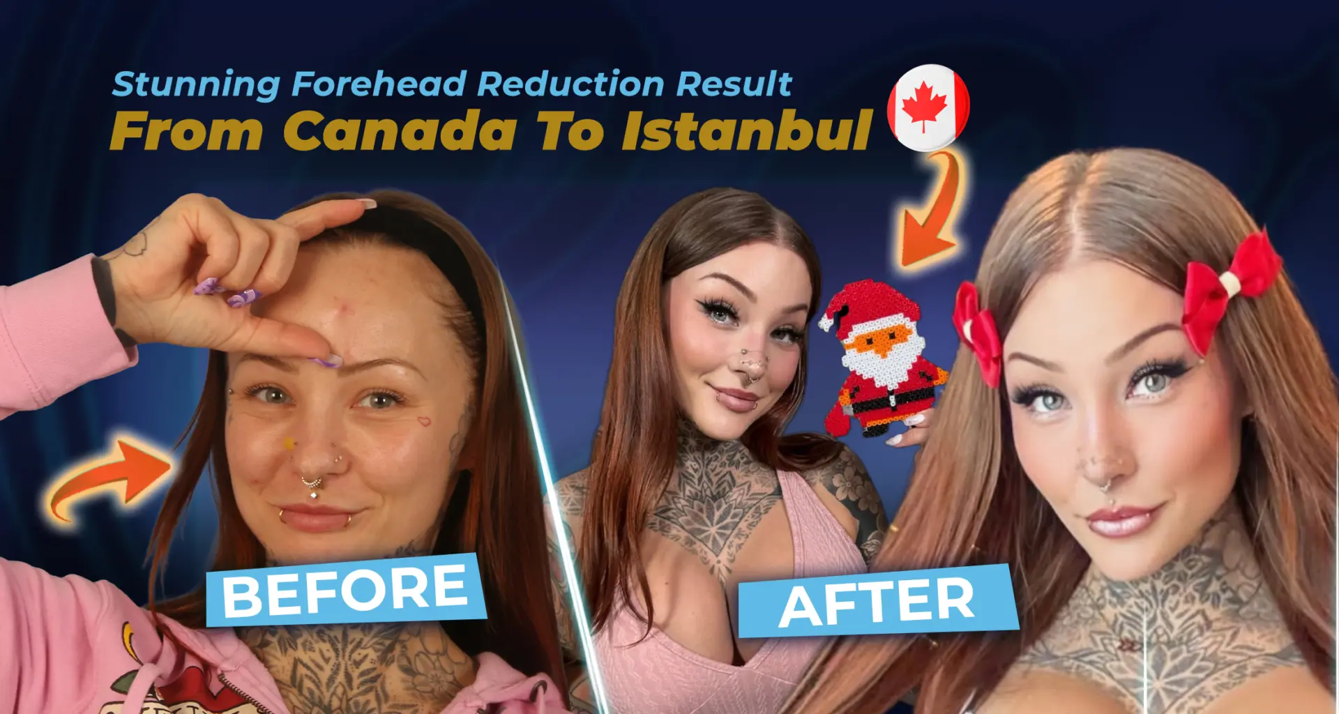 Témoignage d'une patiente ayant bénéficié d'une chirurgie de réduction du front