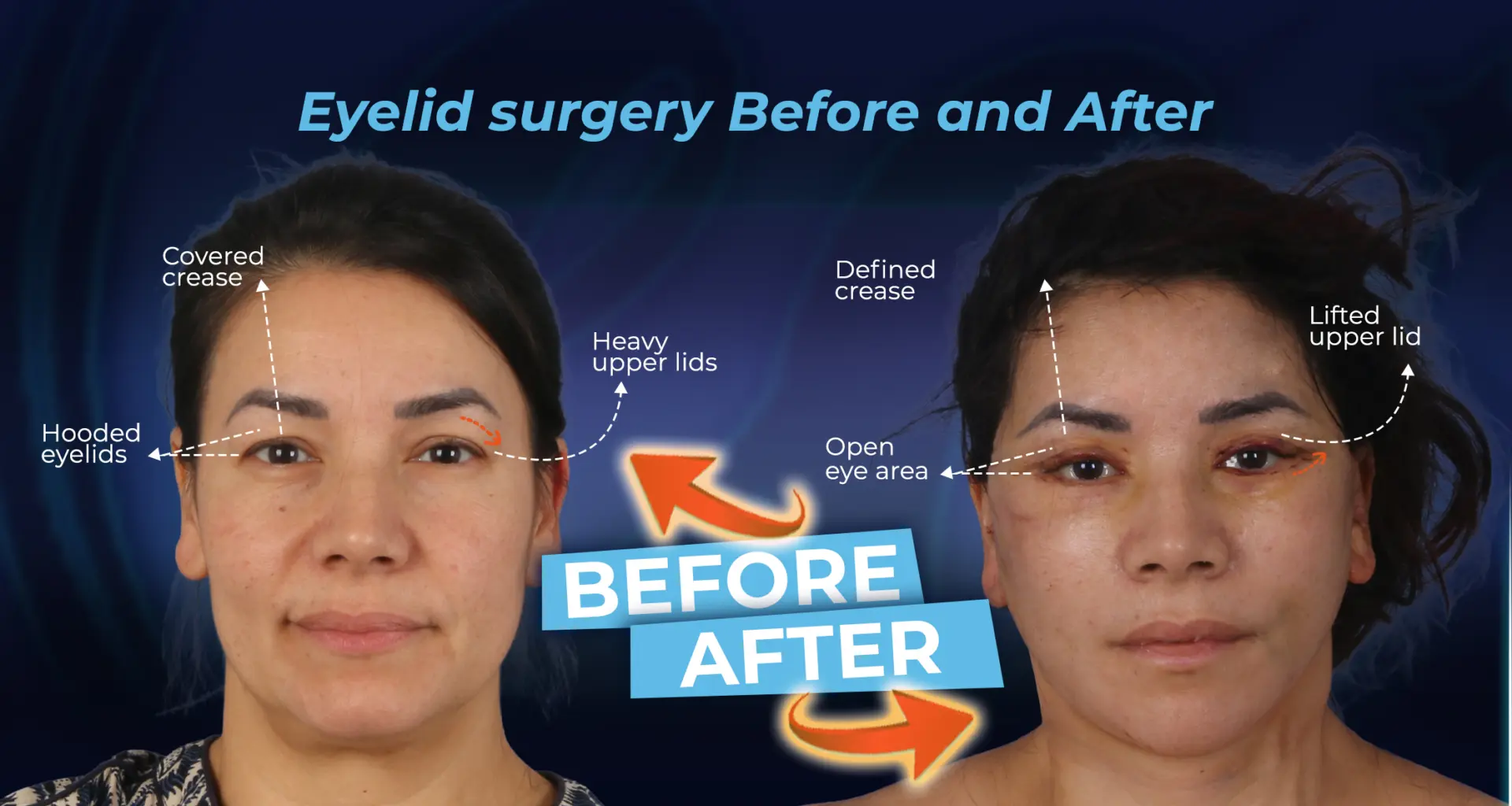 Chirurgie des paupières supérieures ou Botox : quelle est la meilleure solution pour les paupières tombantes ?