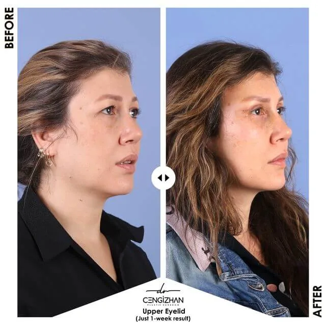 Infographic: Upper eyelid surgery by Dr. Cengizhan (results after 1 week)