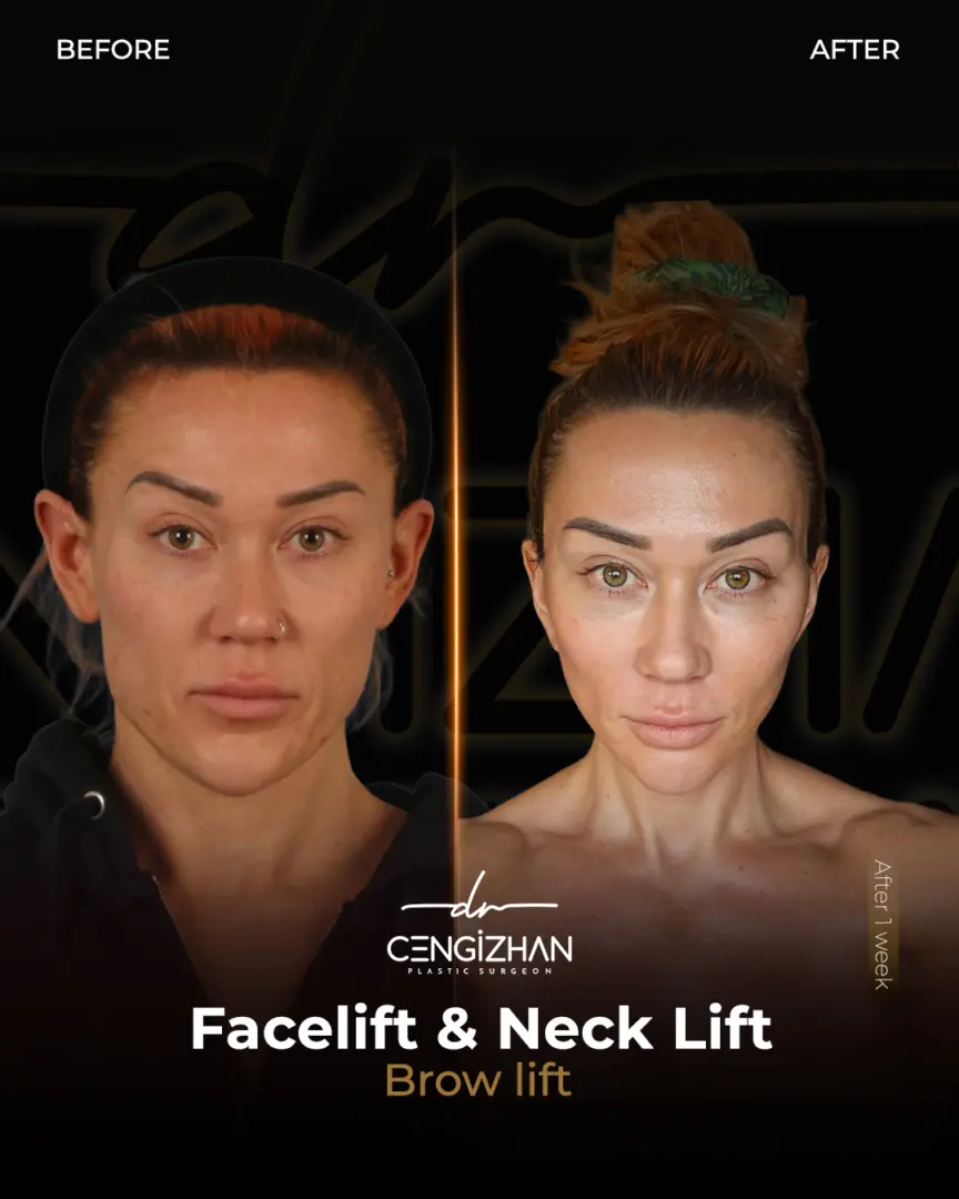 Patient success story: Facelift, necklift, and brow lift transformation