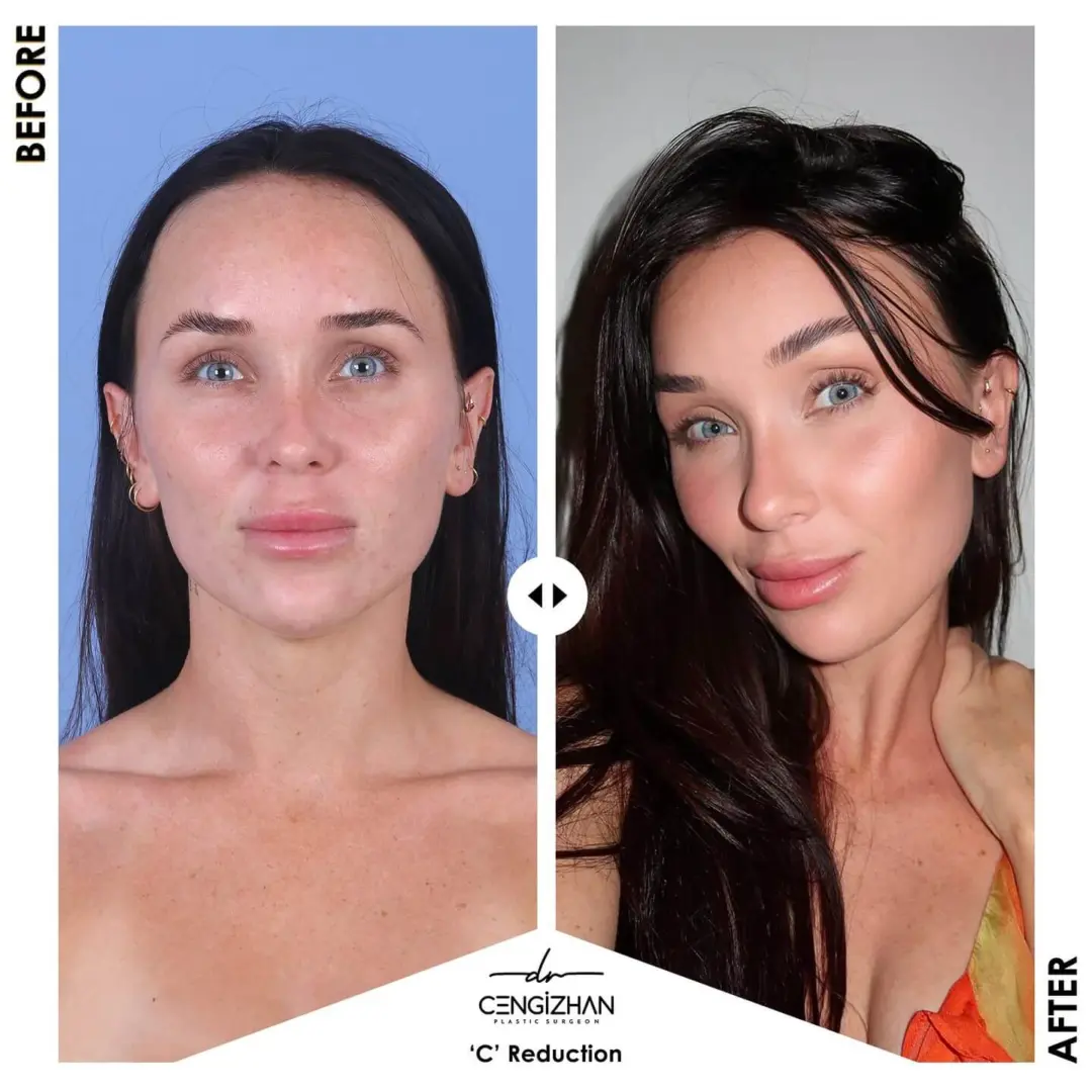 جراحة تصغير الجبهة بتقنية "C" (جراحة خفض خط الشعر قبل وبعد) على يد الدكتور جنكيزهان