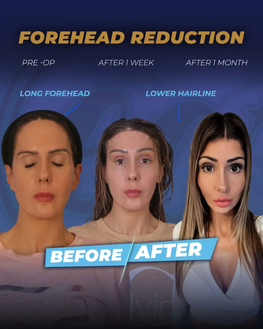 Forehead Reduction Surgery (before and after)patient success story by Dr. Cengizhan