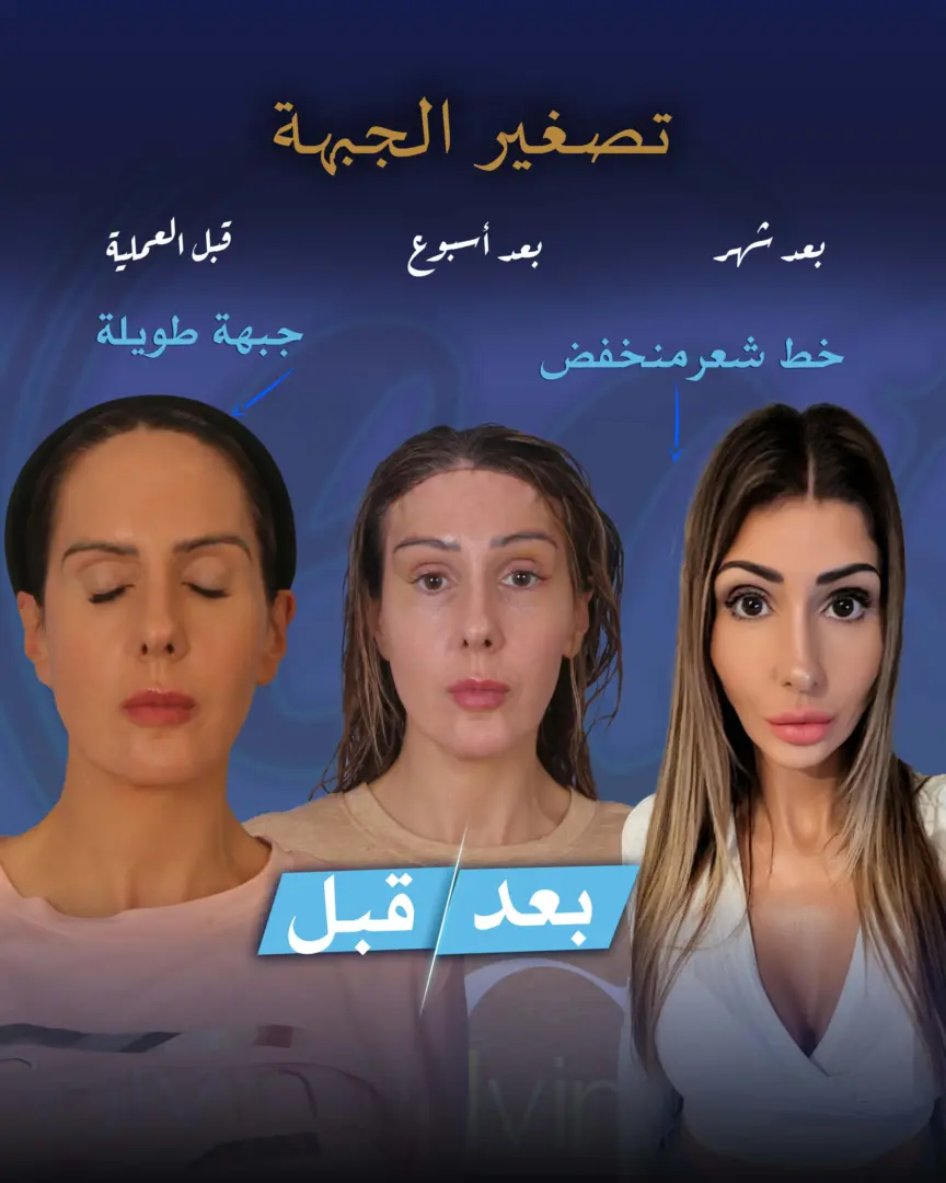 قصة نجاح مريض في جراحة تصغير الجبهة (قبل وبعد) للدكتور جنكيزهان