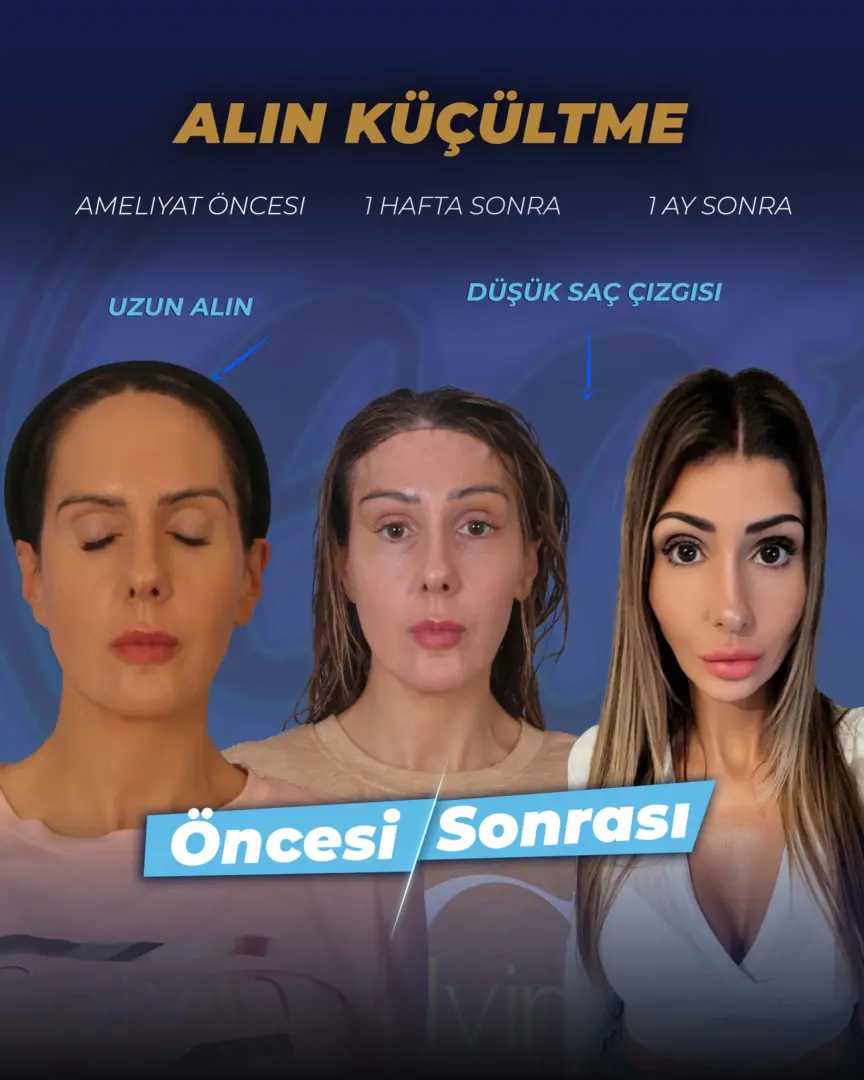 Alın Küçültme Ameliyatı (öncesi ve sonrası) Dr. Cengizhan'ın hasta başarı öyküsü