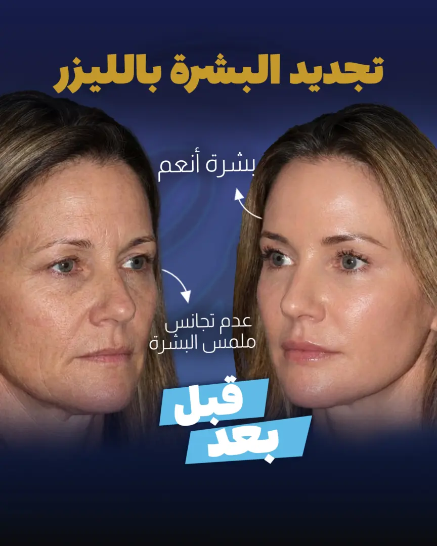 رسم بياني لتقنية تجديد سطح البشرة بالليزر