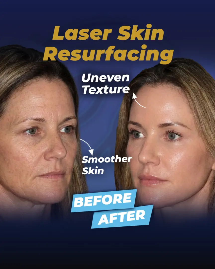 Laser Skin Resurfacing Infographic
