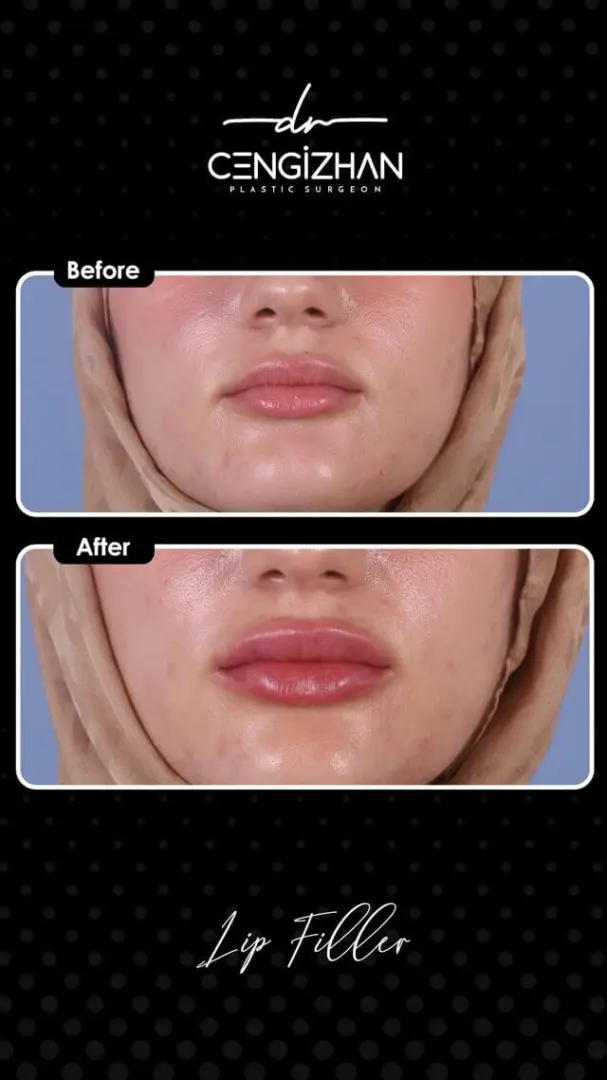 Infographic: Lip Filler (before and after) results by Dr. Cengizhan Ekizceli