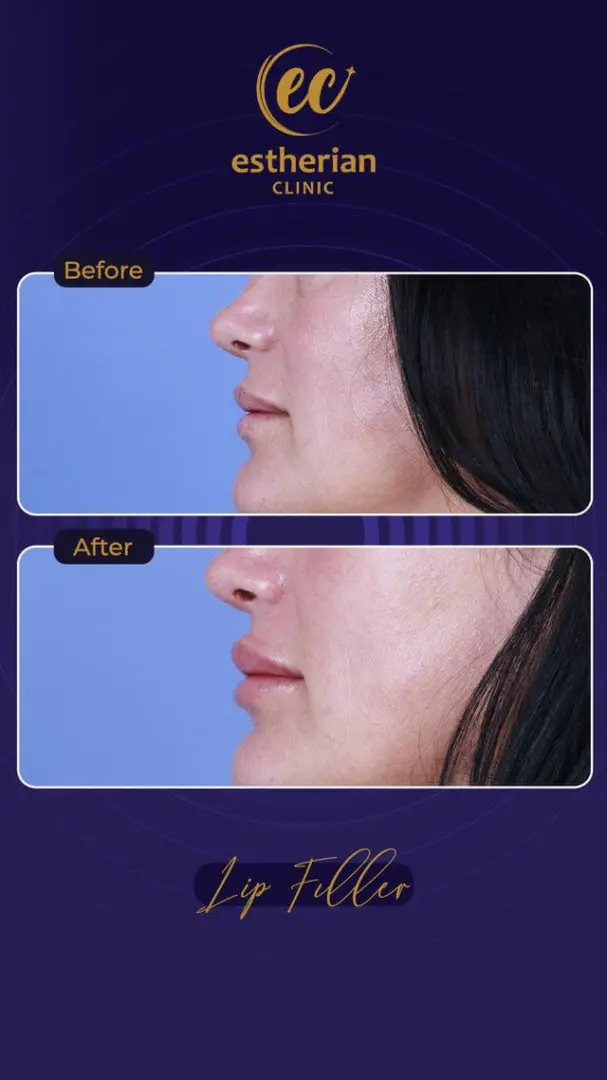 Lip Filler results by the Estherian Clinic