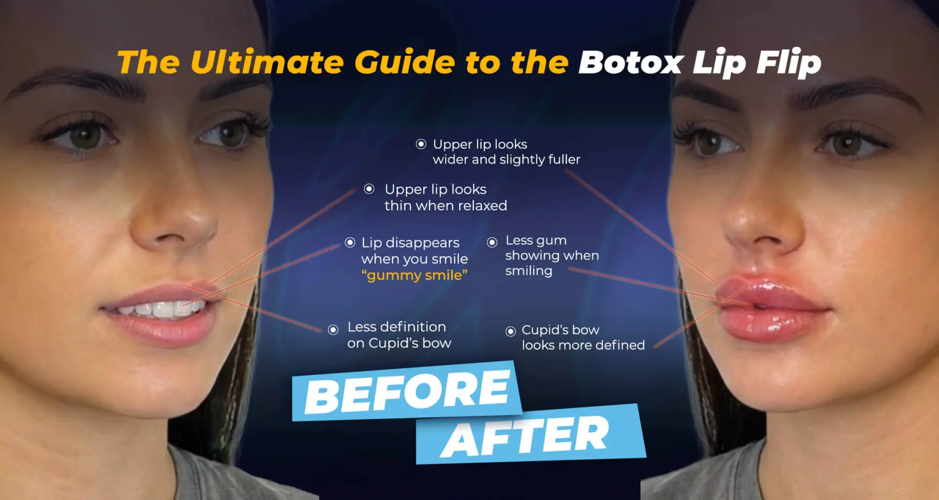 Lip Flip before and after results by the Estherian Clinic