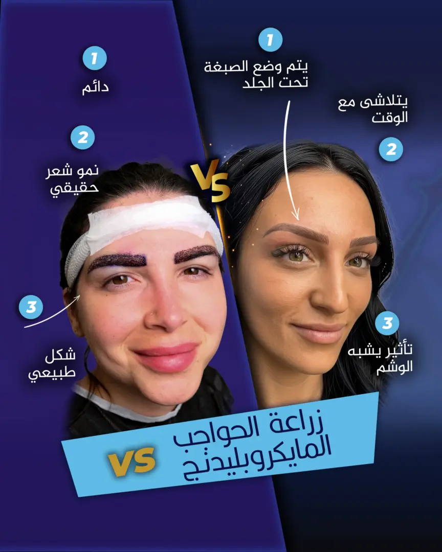 دليل مقارنة بين زراعة الحواجب وتقنية المايكروبليدينغ للدكتور جنكيزهان إيكيزجيلي