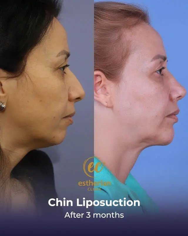 Chin Liposuction before and after by the Estherian Clinic (results after 2 months)