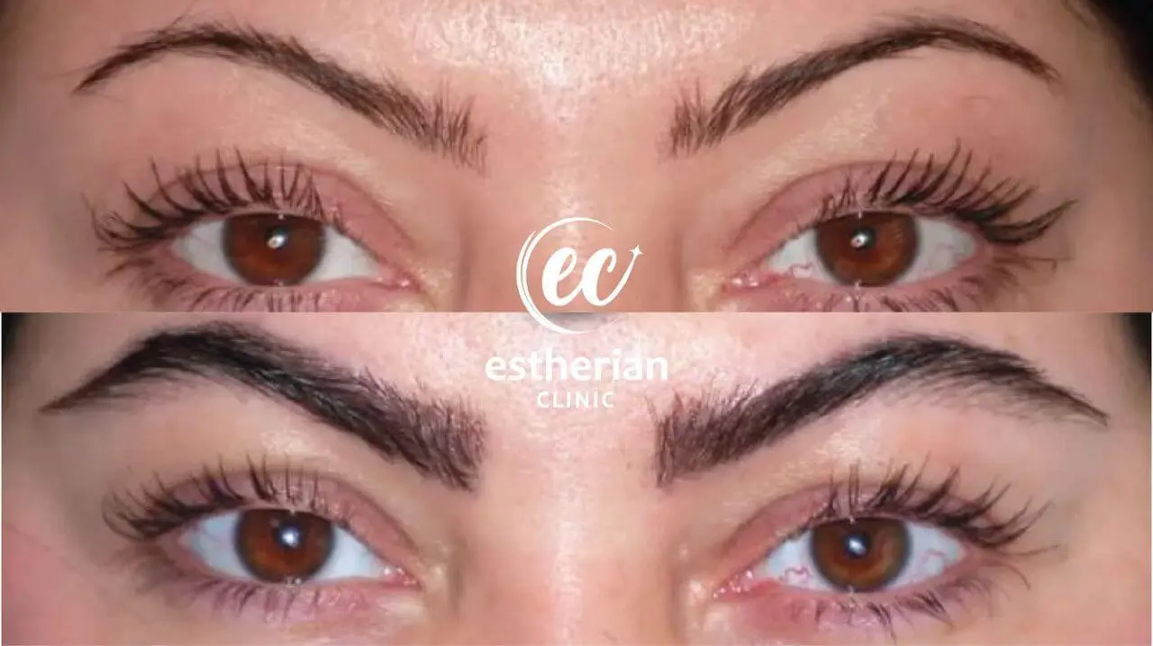 Eyebrow transplant results by the Estherian Clinic (before and after)