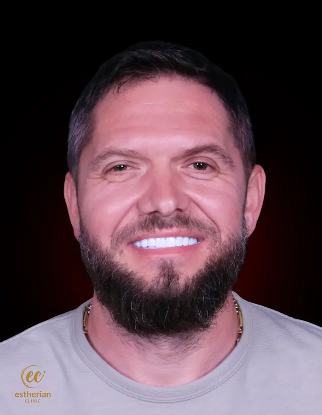 Hollywood Smile by the Estherian Clinic