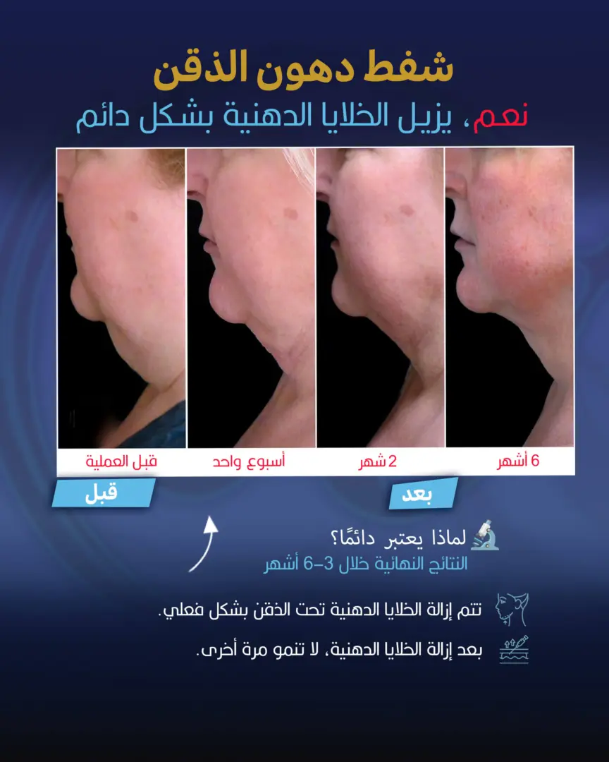 دليل دائم لعملية شفط دهون الذقن بقلم جنكيزهان إيكيزجيلي