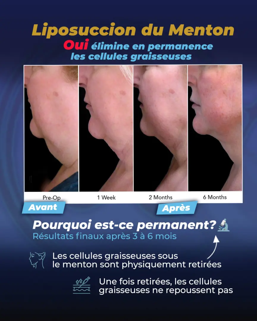 Guide sur la liposuccion du menton : est-elle permanente ? par le Dr Cengizhan Ekizceli