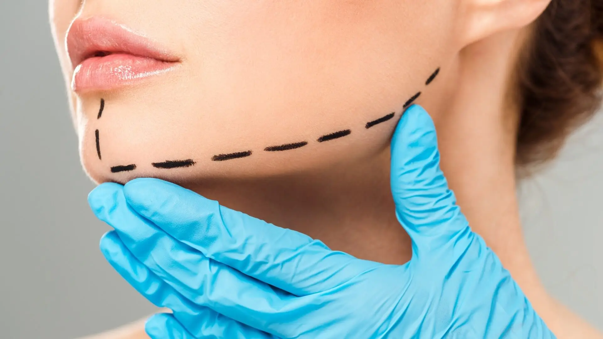 Is chin liposuction permanent