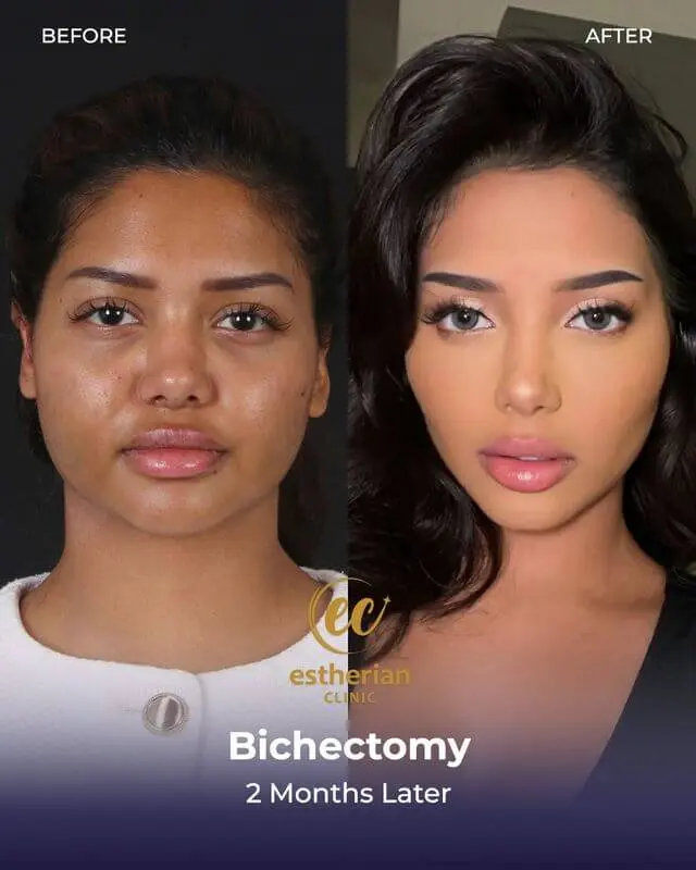 Bichectomy (Buccal fat removal) by the Estherian Clinic