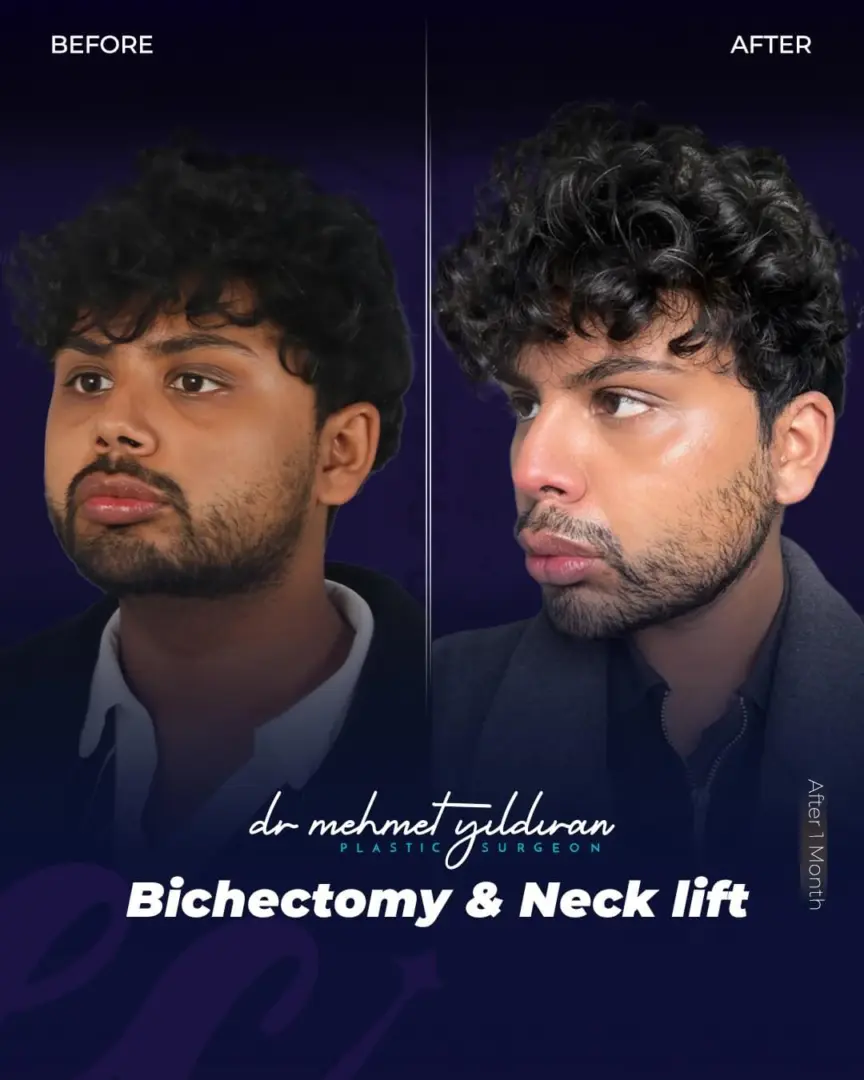 Bichectomy results - Buccal Fat Removal for Men by Dr. Mehmet Yildiran at the Estherian Clinic (real patient transformation)