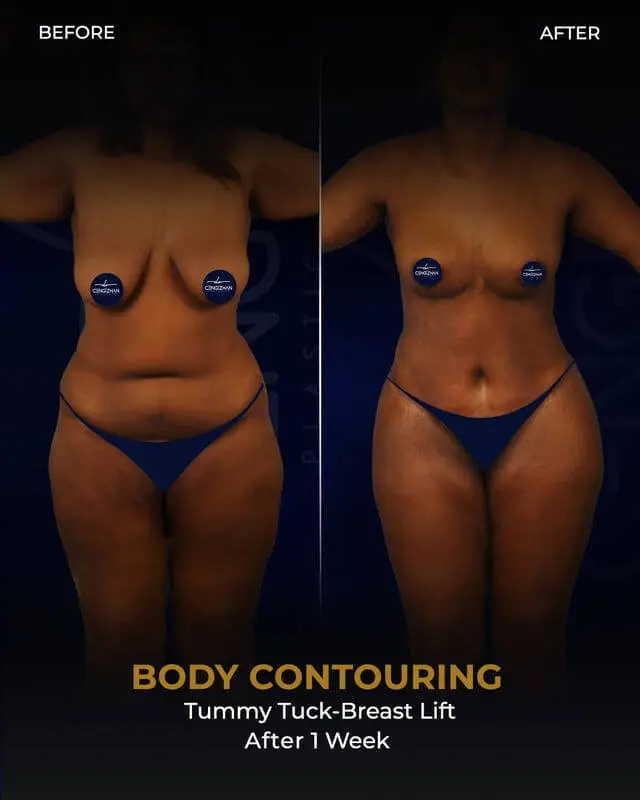 Body Contouring  (Tummy tuck, Breast lift) results after 1 week by Dr. Cengizhan Ekizceli