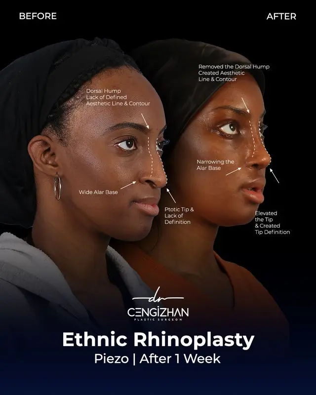 Ethnic rhinoplasty (results 1 week post-operation) by Dr. Cengizhan