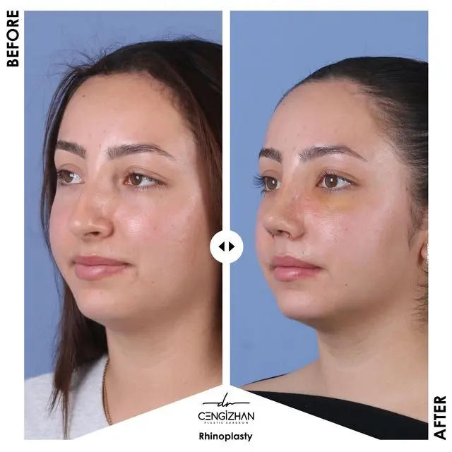Precision rhinoplasty (before and after) by Dr. Cengizhan Ekizceli