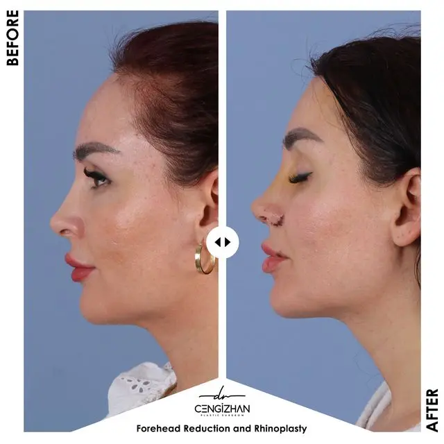 Forehead reduction and finishing rhinoplasty by Dr. Cengizhan