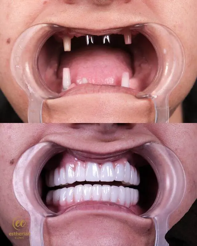 Hollywood Smile  (close-up results) before-and-after by the Estherian Clinic