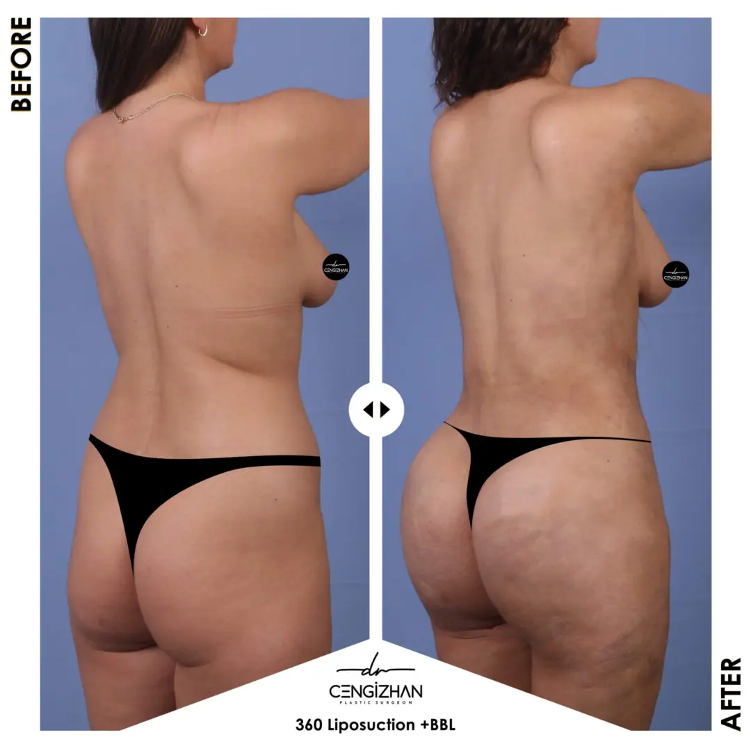 عملية شفط الدهون 360 درجة وتحويل المؤخرة البرازيلية على يد الدكتور جنكيزهان إيكيزجيلي