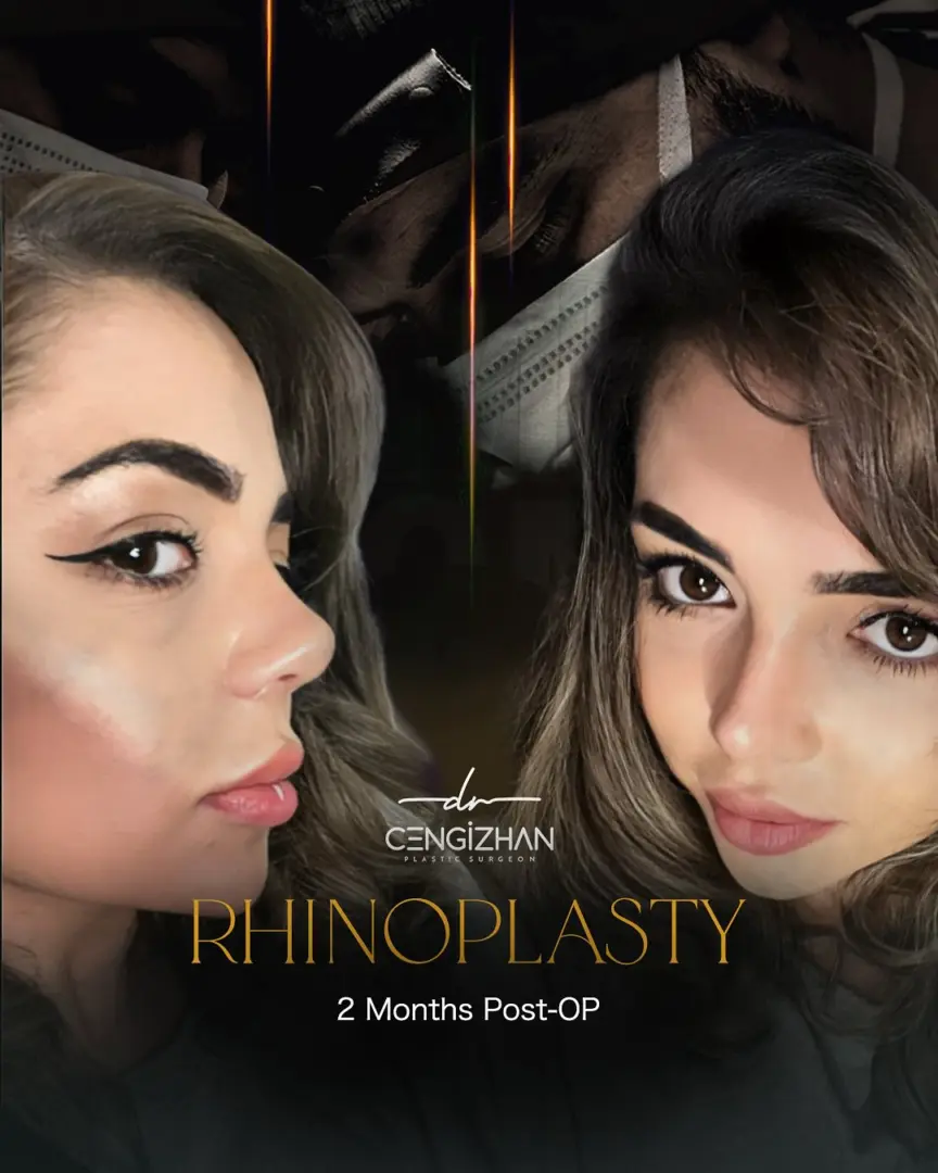 A Rhinoplasty Transformation by Dr. Cengizhan Ekizceli (2 Months Post-op)