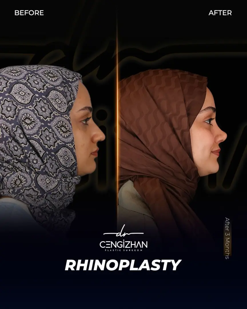 Dr. Cengizhan Ekizceli (real patient transformation) Rhinoplasty results (3 Months Post-op)