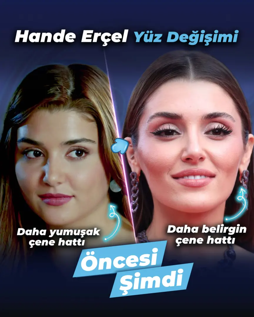 Hande Ercel'in Estetik Ameliyatı (öncesi ve sonrası) Estherian Kliniği tarafından