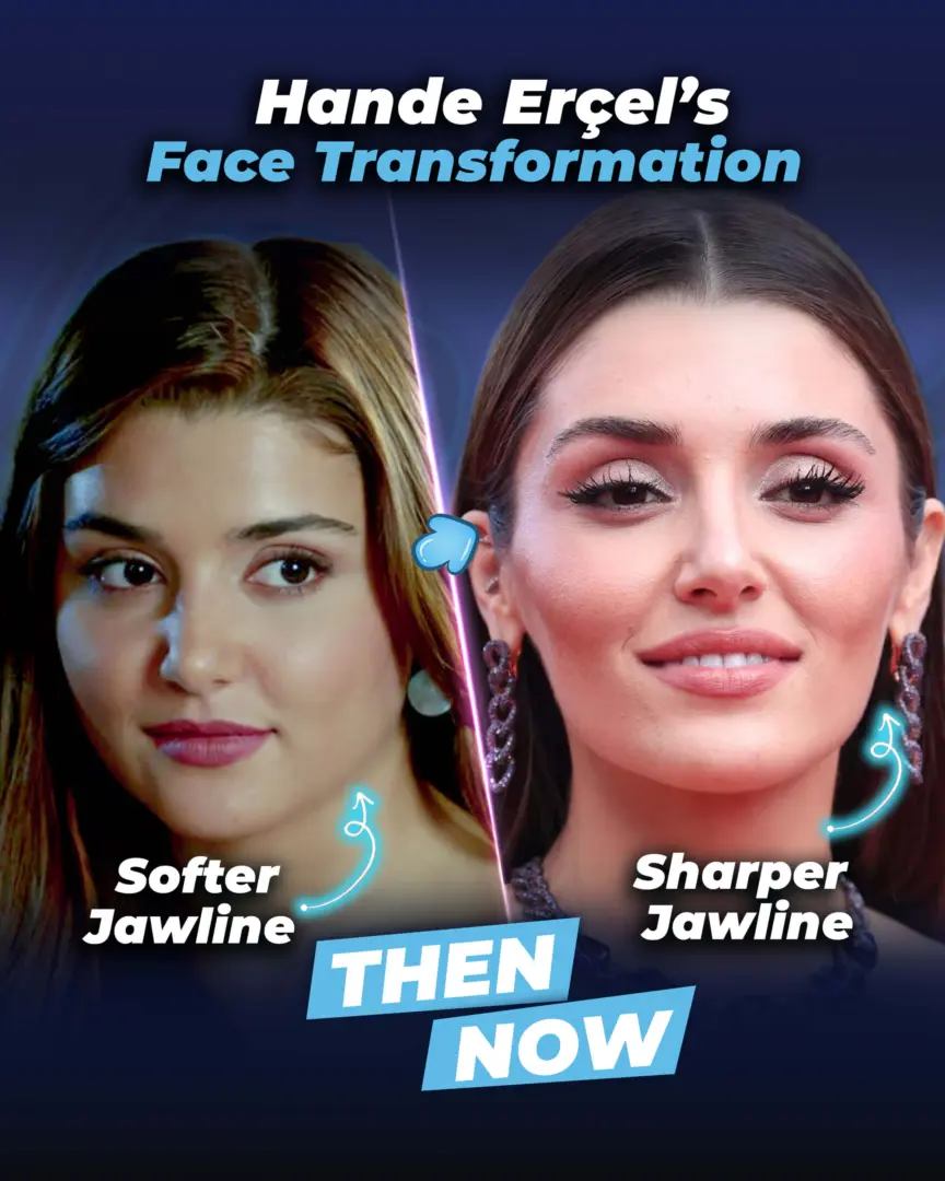 Hande Ercel's Plastic Surgery (before and after) by the Estherian Clinic