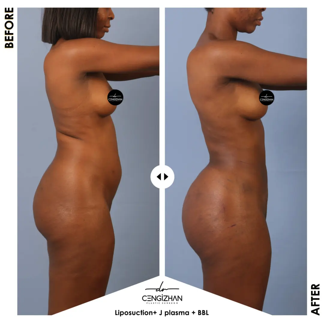 شفط الدهون + بلازما جي + تكبير المؤخرة البرازيلية على يد الدكتور سينجزيهان إيكيزجيلي