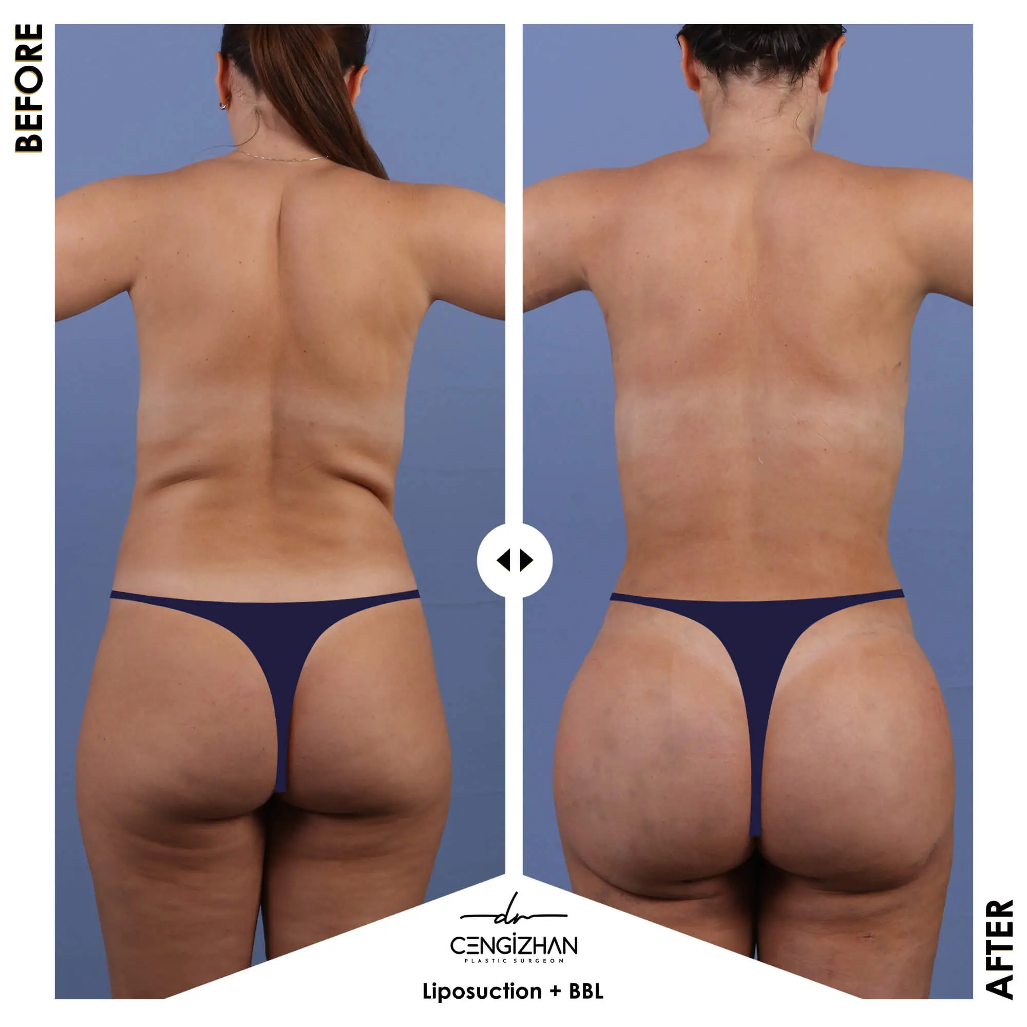 Liposuction and BBL results by Dr. Cengizhan Ekizceli (Real Patient Transformation)