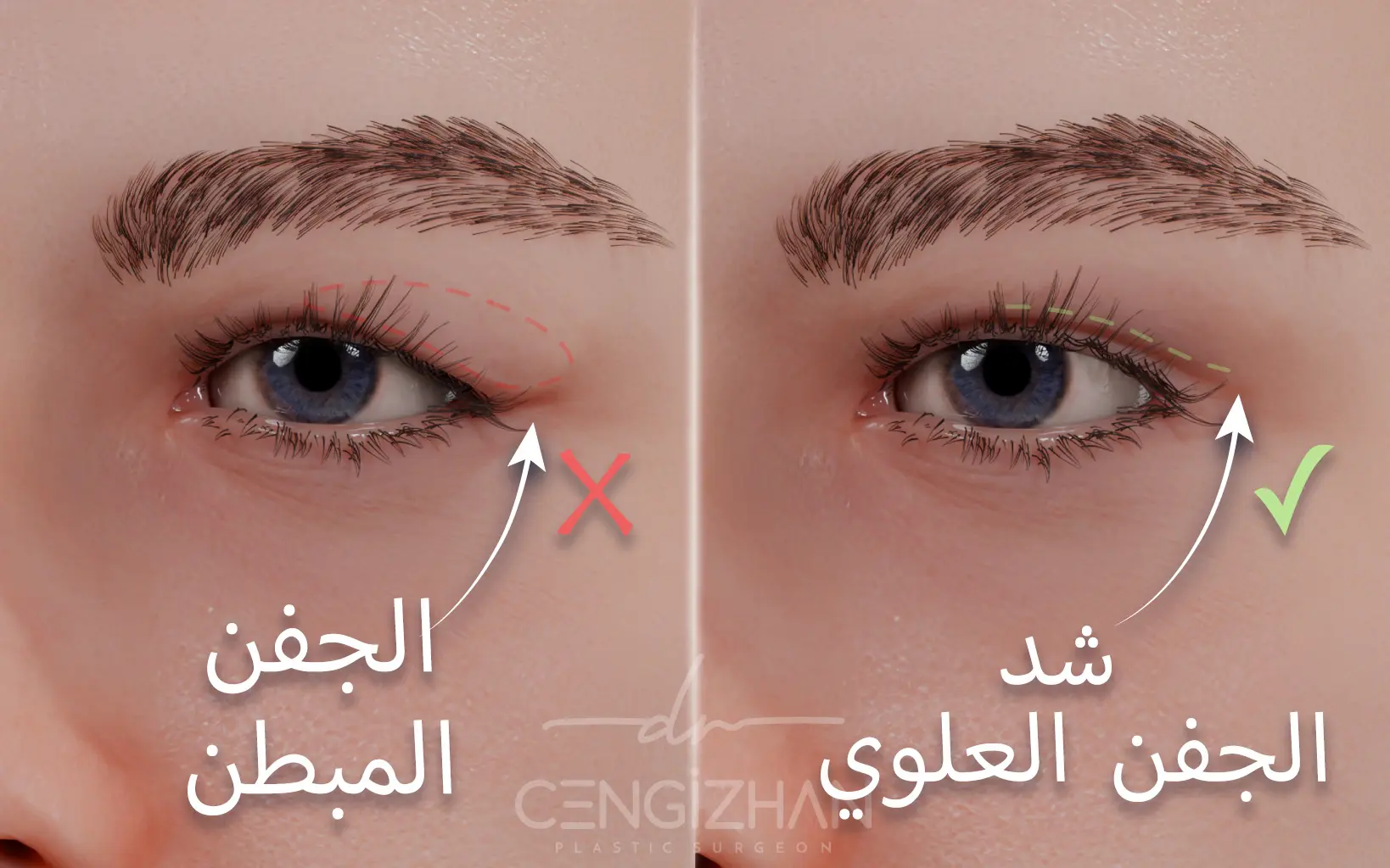 صورة ثلاثية الأبعاد توضح نتائج جراحة الجفن العلوي