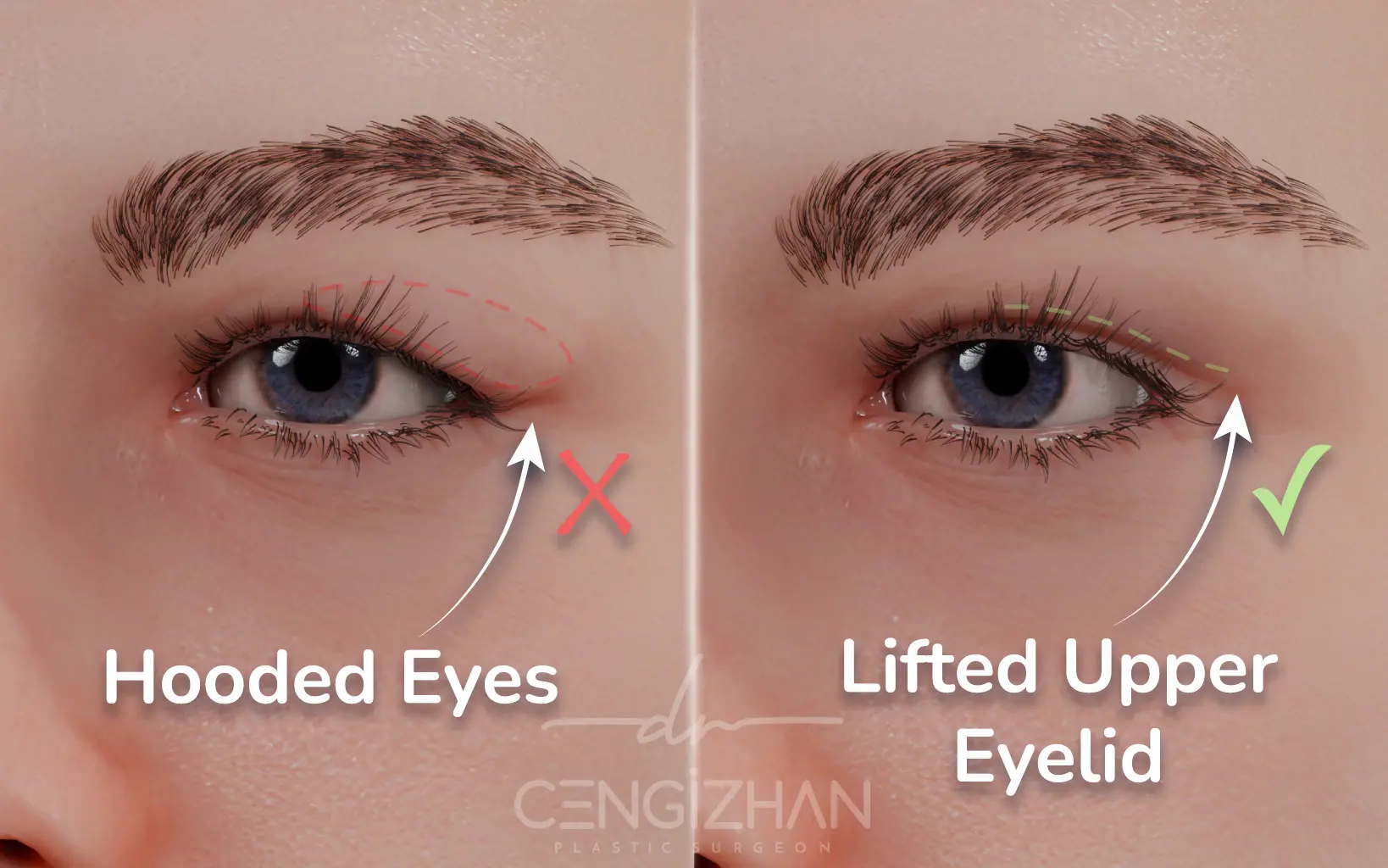 A 3-D Image Demonstrating the  Results of an Upper Eyelid Surgery