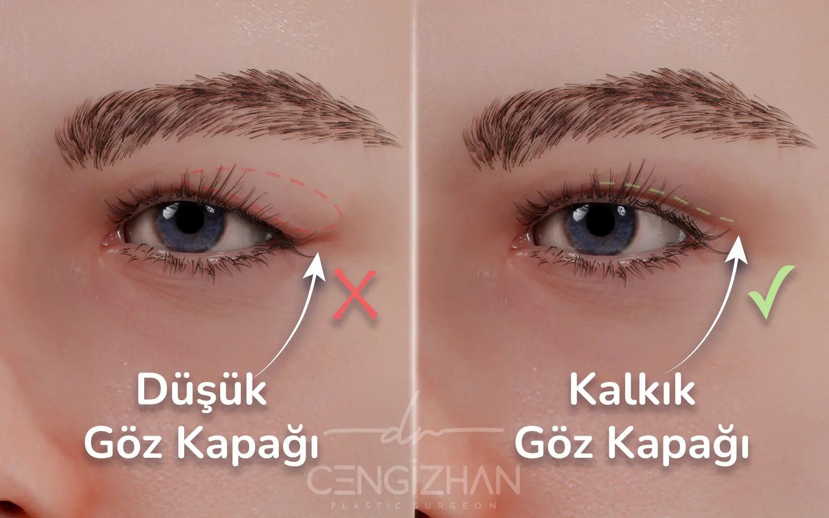 Üst göz kapağı ameliyatının sonuçlarını gösteren 3 boyutlu bir görüntü.