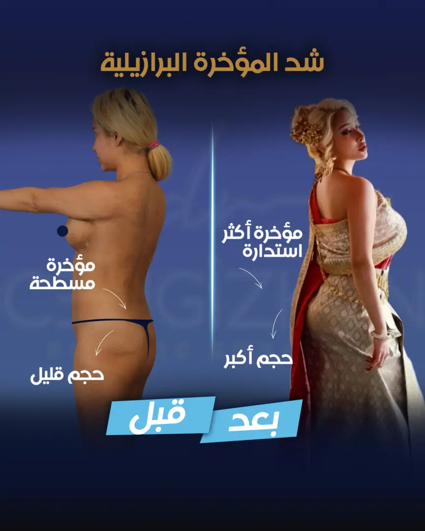 عملية تكبير المؤخرة البرازيلية (نتائج حقيقية لمرضى) للدكتور جنكيزهان إيكيزجيلي