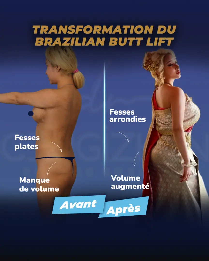 Transformation par lifting brésilien des fesses (résultats de vraies patientes) par le Dr Cengizhan Ekizceli