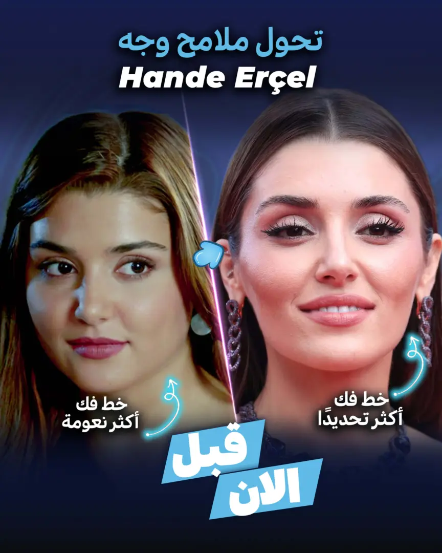 جراحة التجميل التي خضعت لها هاندي إرتشيل (قبل وبعد) في عيادة إستيريان