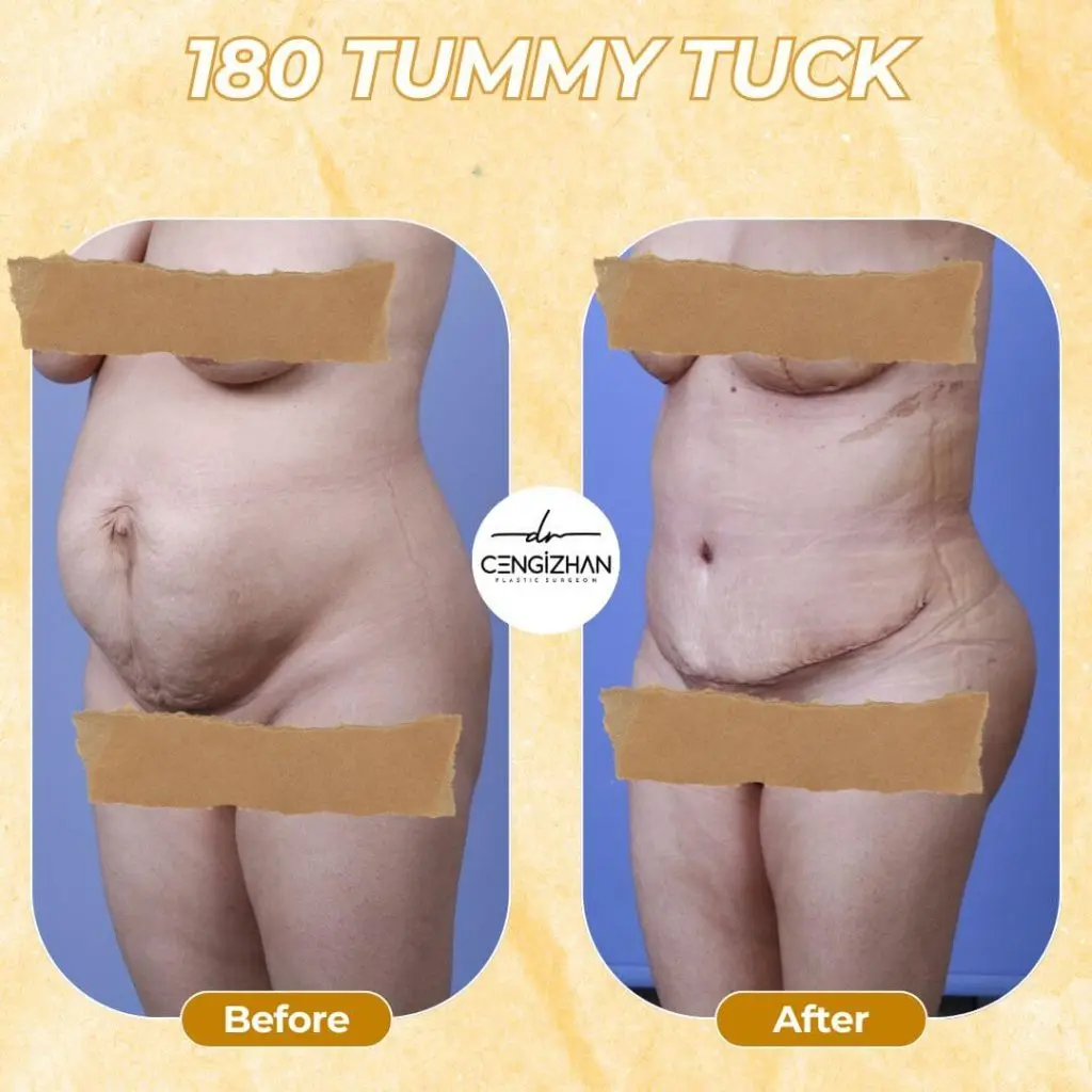 Vorher-Nachher: 180° Tummy Tuck (Standard-Bauchdeckenstraffung) in der Türkei – gestraffter Bauch in der Seitenansicht.