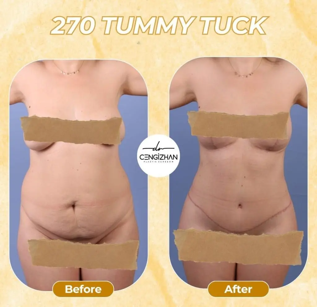 Vorher-Nachher: 270° Tummy Tuck (Extended-Bauchdeckenstraffung) in der Türkei – gestraffter Bauch und definierte Taille.