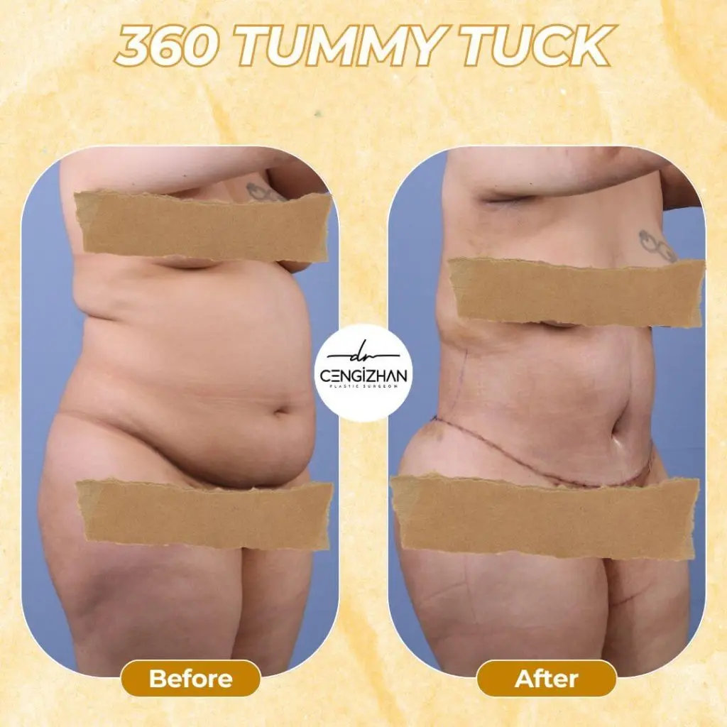 Vorher-Nachher: 360° Tummy Tuck (Belt Lipectomy) in der Türkei – rundum gestraffter Bauch in der Seitenansicht.