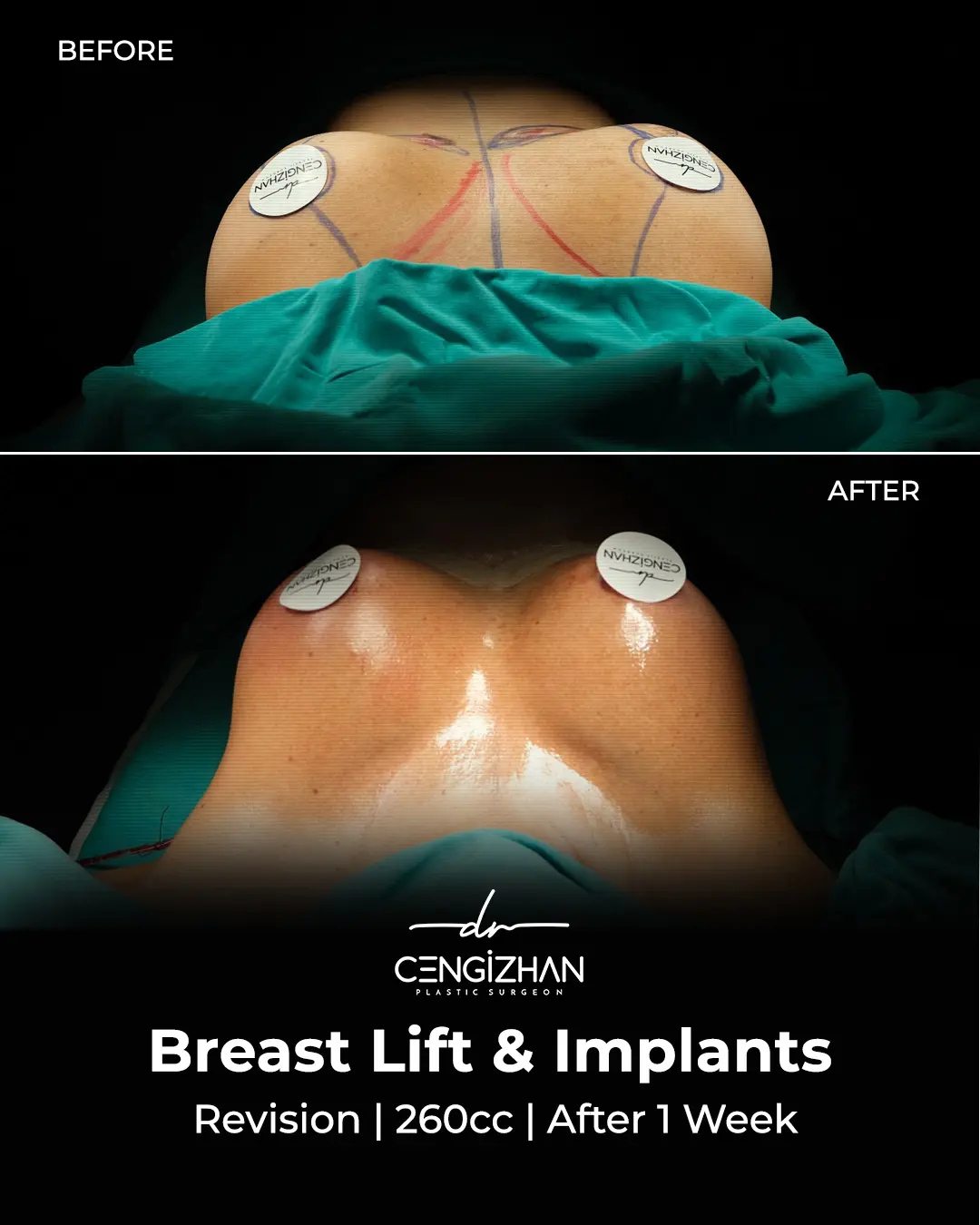 Breast Implant Before and After by Dr. Cengizhan Ekizceli